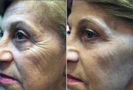 Πριν και μετά τη χρήση 3 Bioretin